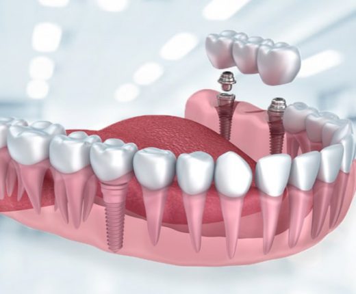 Diş İmplantı Tedavisi