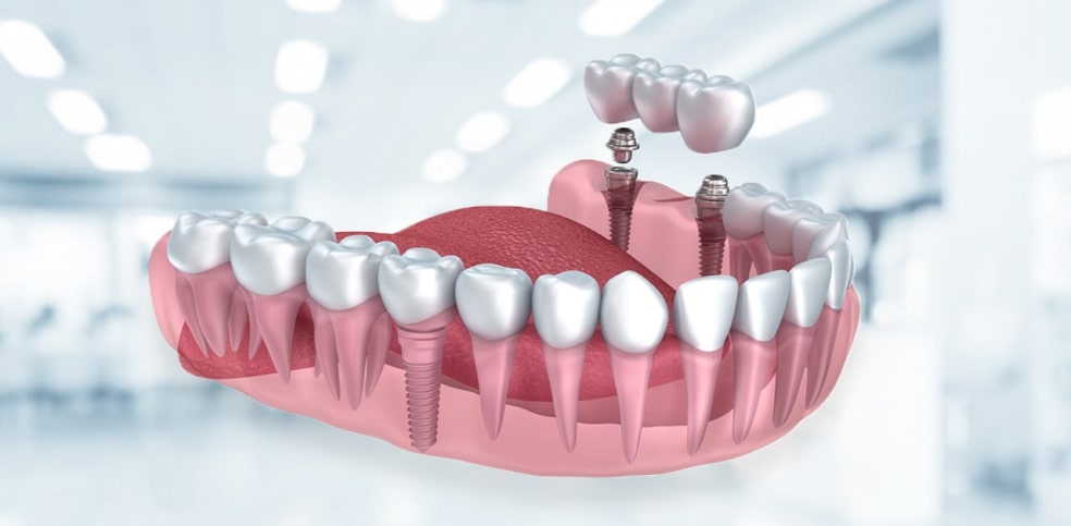 Diş İmplantı Tedavisi