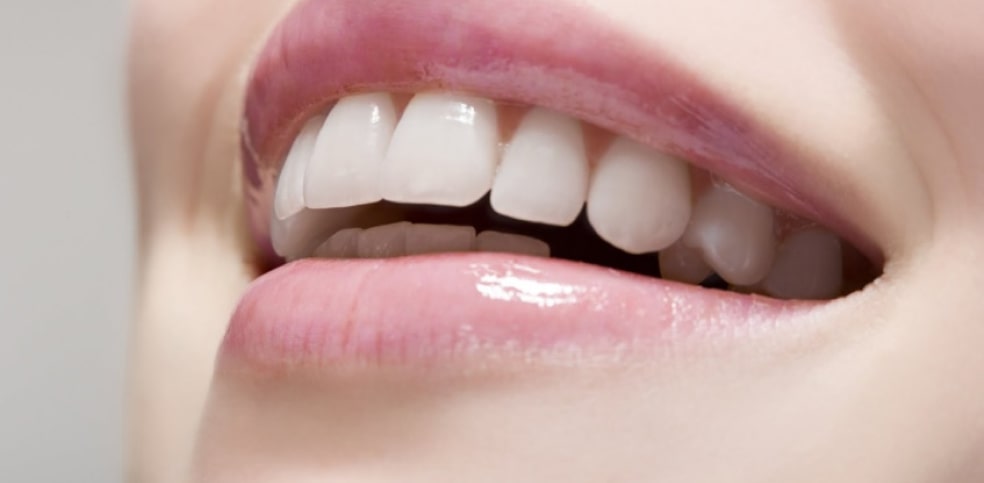 Laminate Veneer Kaplama