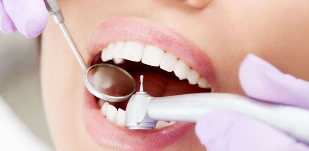 Diş Taşı ve Tartar Temizliği